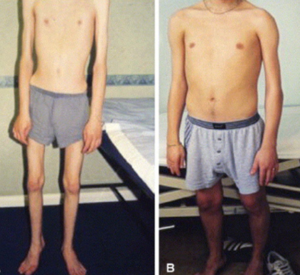 Muscle Atrophy and Remodeling